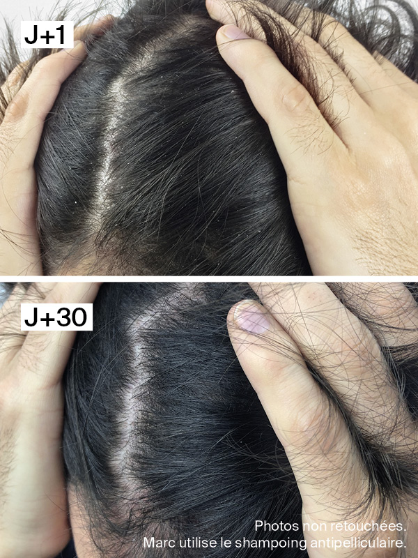 Shampoing Antipelliculaire Doux