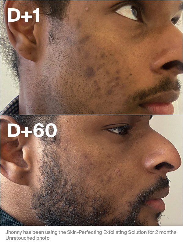 Skin-Perfecting Exfoliating Solution