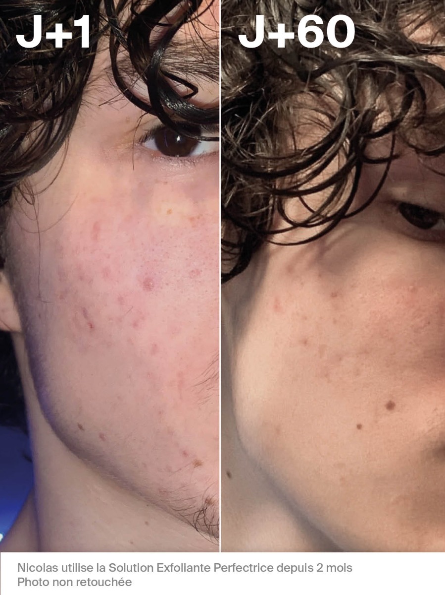 Solution Exfoliante Perfectrice